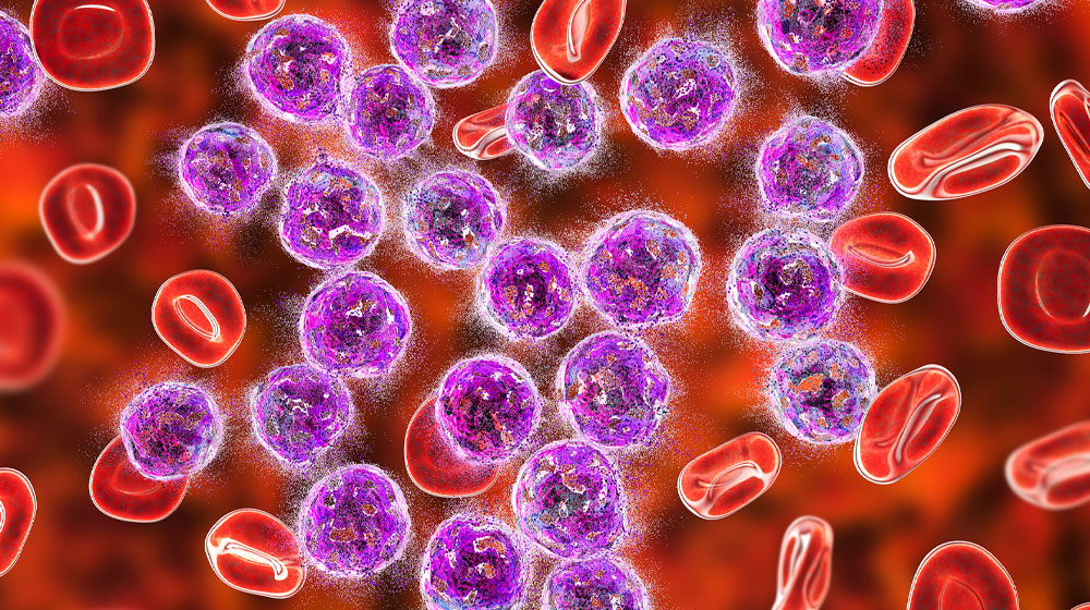 Artificial Intelligence in the Management of Leukemia